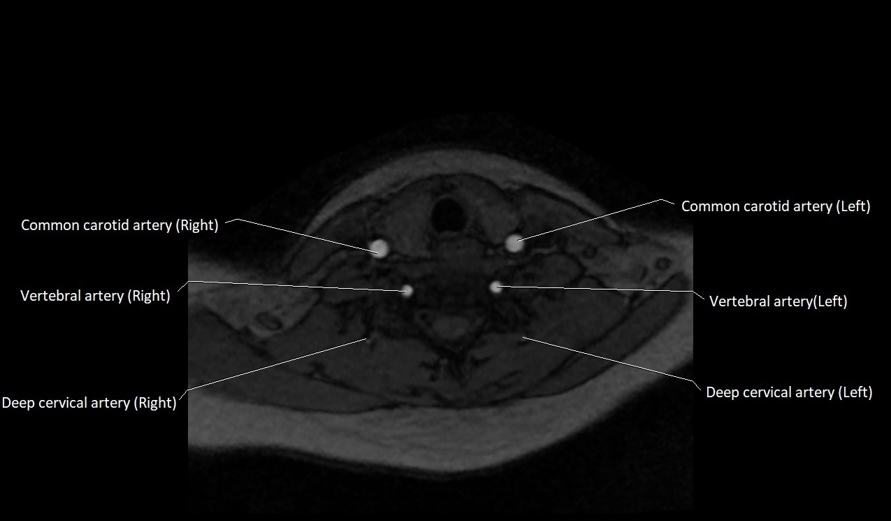 Carotid artery anatomy axial 3T image 50.jpg